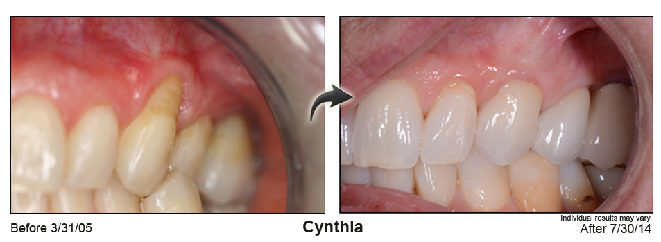 Brighton Colorado gum rejuvenation