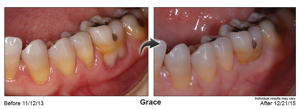 fix gum recession Brighton Colorado