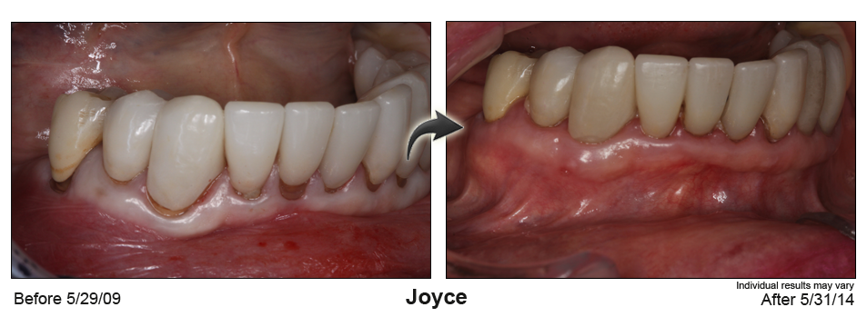pinhole gum rejuvenation Brighton Colorado