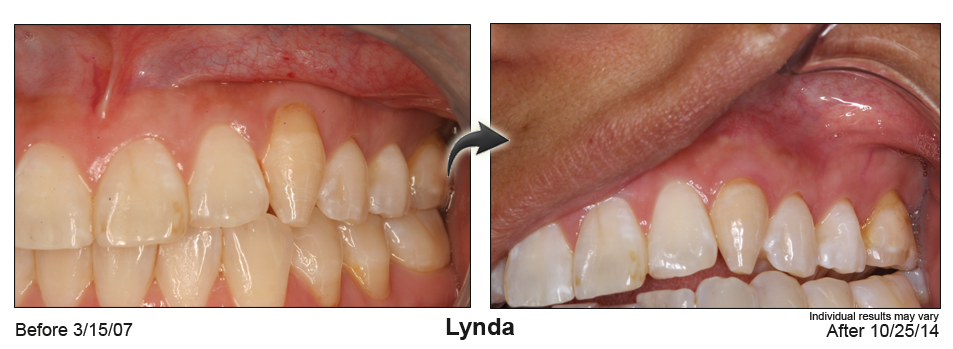 Brighton Colorado lunchtime gumlift dentist