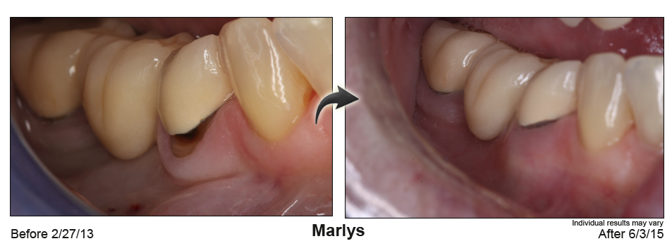 fix receding gums Brighton Colorado
