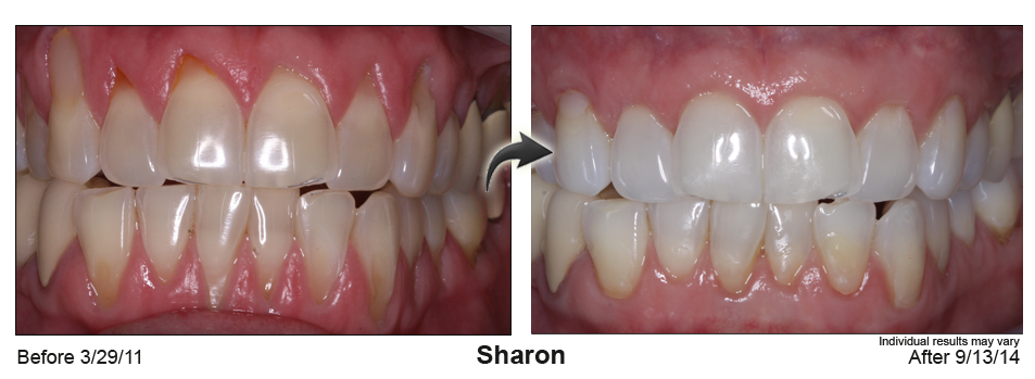 gum recession treatment Brighton Colorado